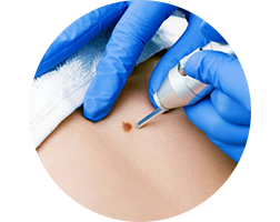 biopsy