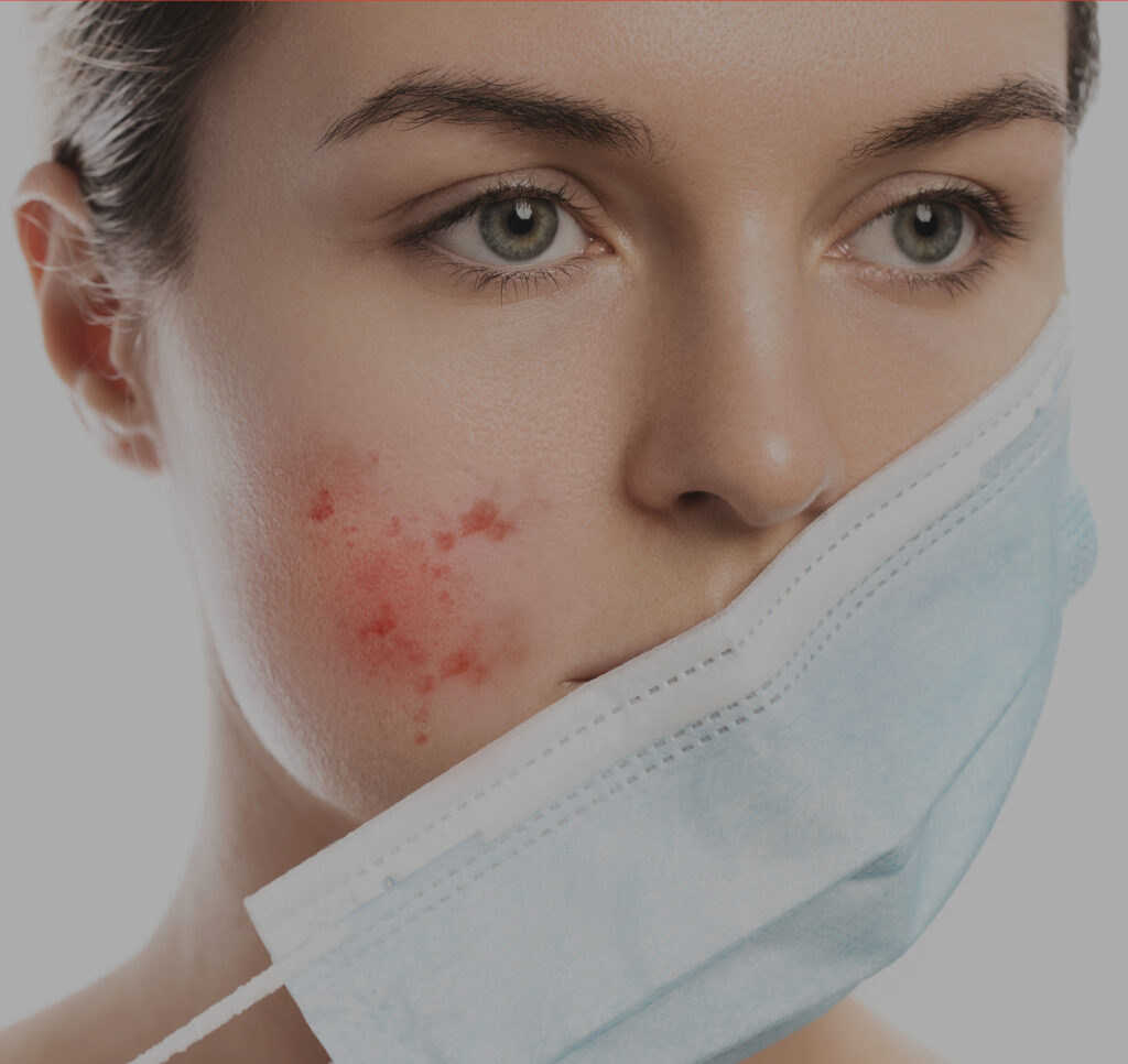 rosacea